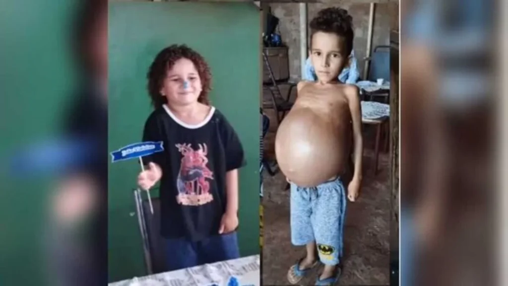 Criança de 6 anos desenvolve doença rara comum apenas em adultos