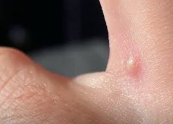 Aluna com suspeita de monkeypox é isolada e escolas adotam medidas preventivas em Sete Lagoas