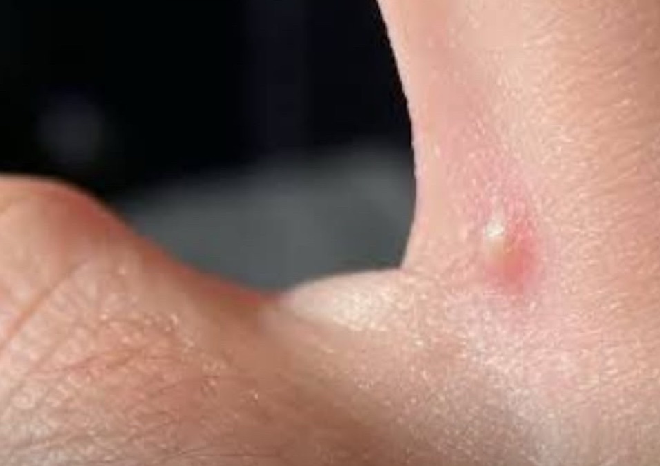 Aluna com suspeita de monkeypox é isolada e escolas adotam medidas preventivas em Sete Lagoas