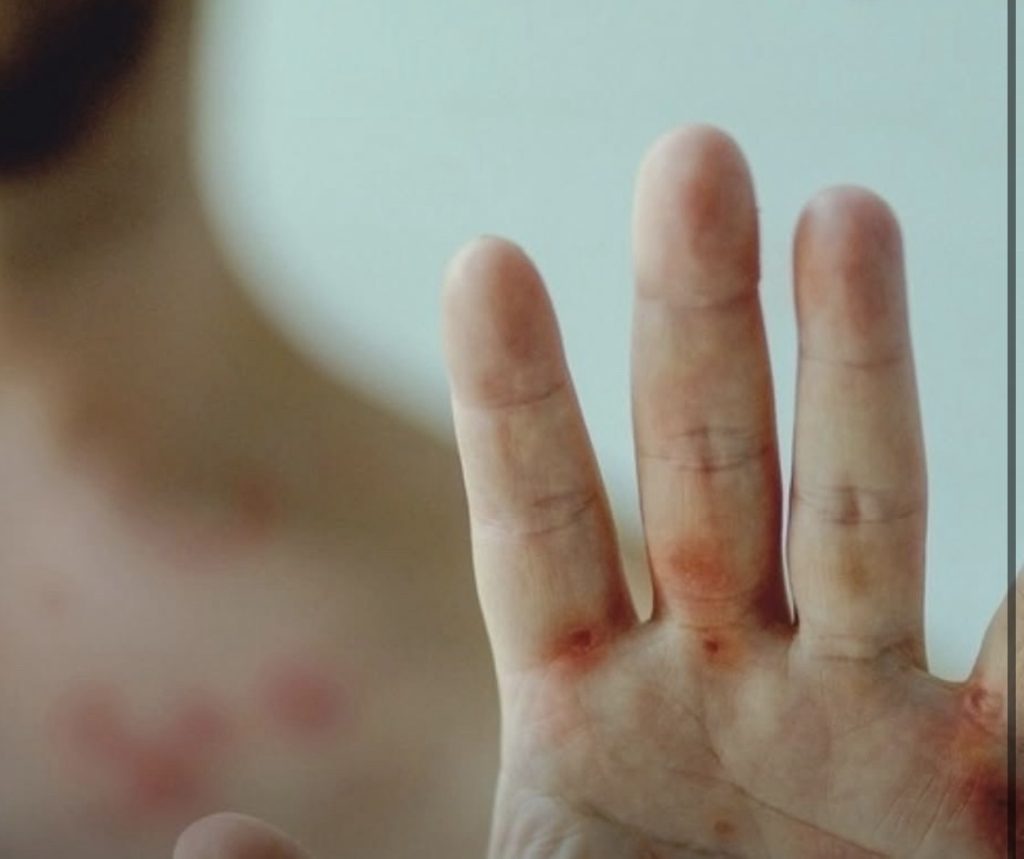 Lagoa Santa monitora caso suspeito de Mpox; Sete Lagoas descarta dois registros