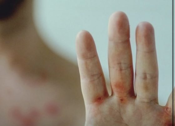 Lagoa Santa monitora caso suspeito de Mpox; Sete Lagoas descarta dois registros